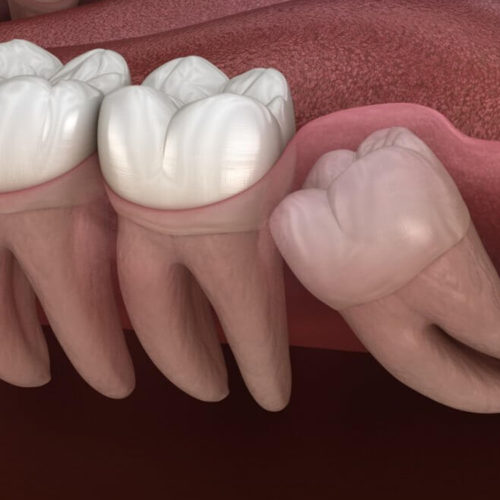 Wisdom Teeth Extraction (Surgery)