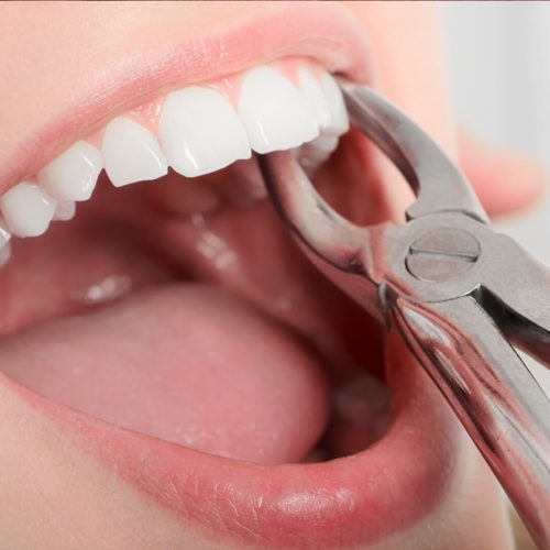 Tooth Extraction (Surgery)
