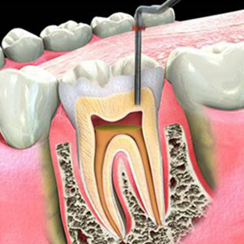 Root Canal Treatment / Endodontics