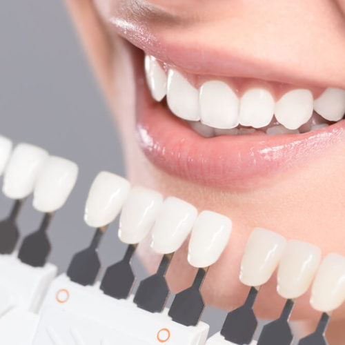 Laminate Veneers
