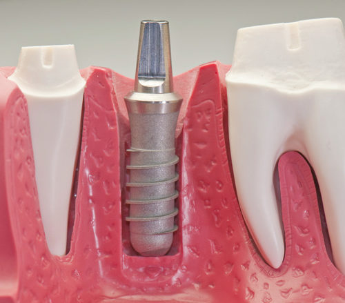 Personalized Implant