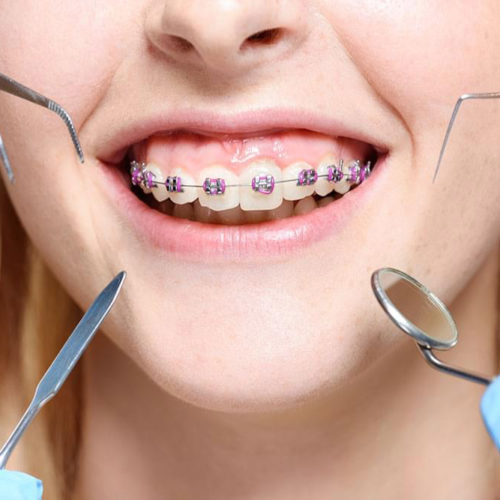 Orthodontics / Braces Treatment